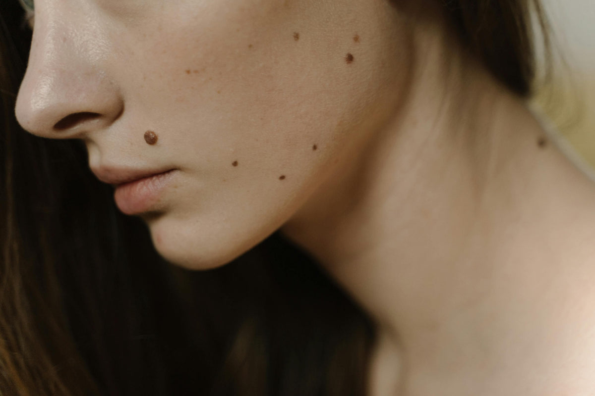 NIGELLE ET PEAUX INFLAMMATOIRES : CE QUE LA RECHERCHE DIT SUR L'ECZÉMA, LE PSORIASIS ET LA DERMATITE